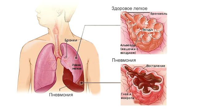 Пневмония во время беременности